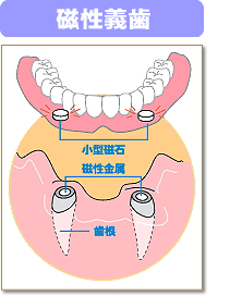 磁性義歯