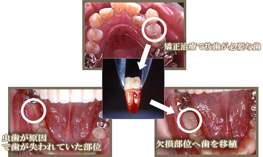 矯正治療と歯の移植を組み合わせ